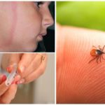 Les effets d'une morsure de tique