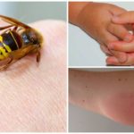 Réaction allergique à la piqûre de guêpe