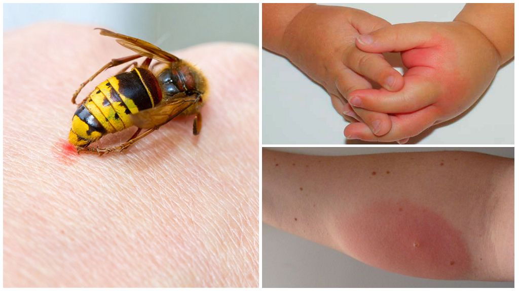Réaction allergique à la piqûre de guêpe