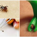 Retrait des tiques