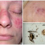 Tique sous-cutanée sur le visage