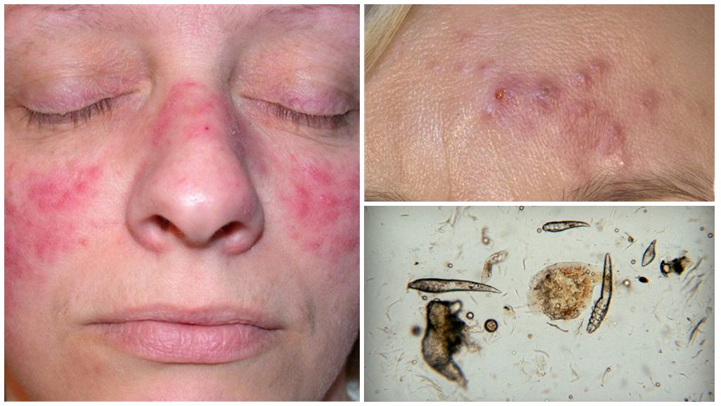 Tique sous-cutanée sur le visage
