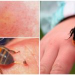 Piqûres d'insectes
