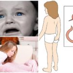 Oxyures chez les enfants