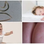 Oxyures chez les enfants jusqu'à un an