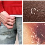 Les oxyures chez l'homme