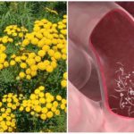 Tanaisie avec entérobiose