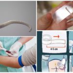 Diagnostic de l'entérobiose