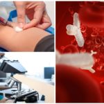Test sanguin pour les anticorps anti-Giardia