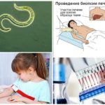 Diagnostic de la toxocarose