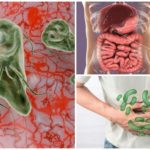 Giardiase