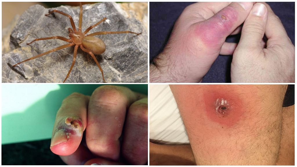 Conséquence d'une morsure d'araignée ermite