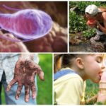 Causes de l'infection à Giardia